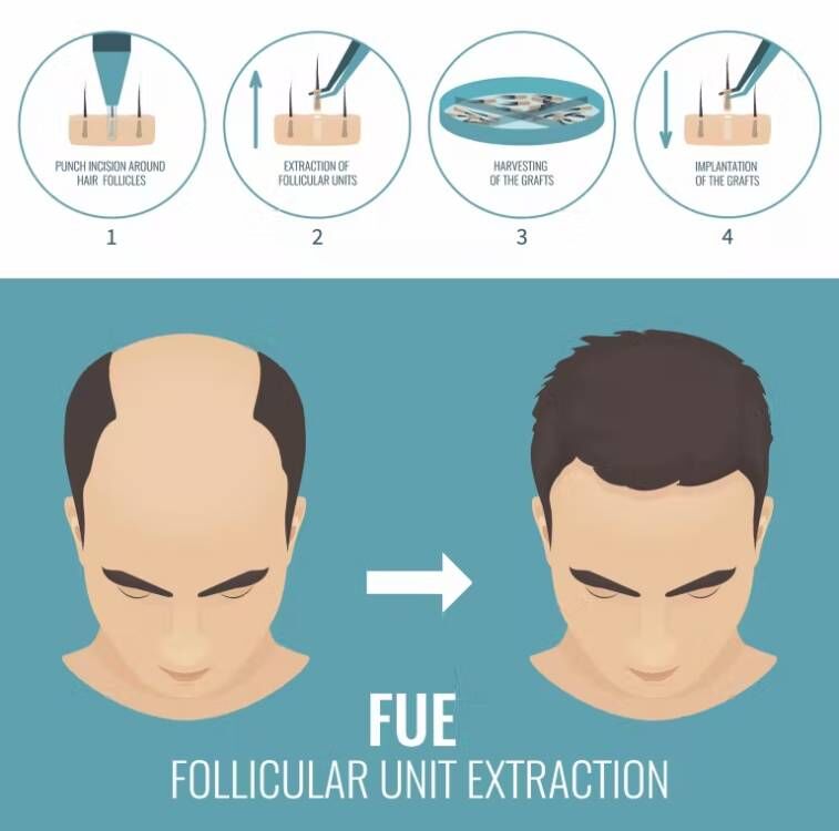 FUE-Micro Motor Máquina De Tra - Hair Care Vegan avaliação e preço